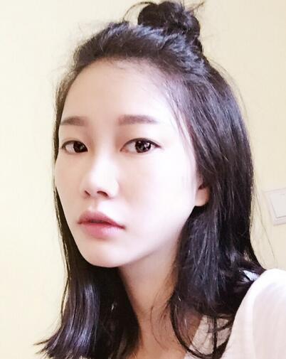 西安陽光整形醫(yī)院邵萍醫(yī)生做鼻綜合整形怎么樣？附鼻綜合整形案例