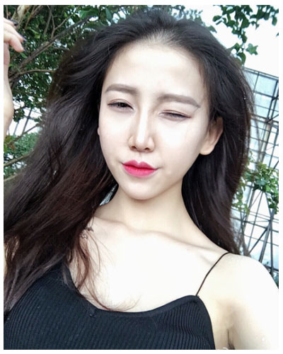 珠海海大整形美容外科黃發(fā)醫(yī)生做面部吸脂怎么樣？附面部吸脂案例