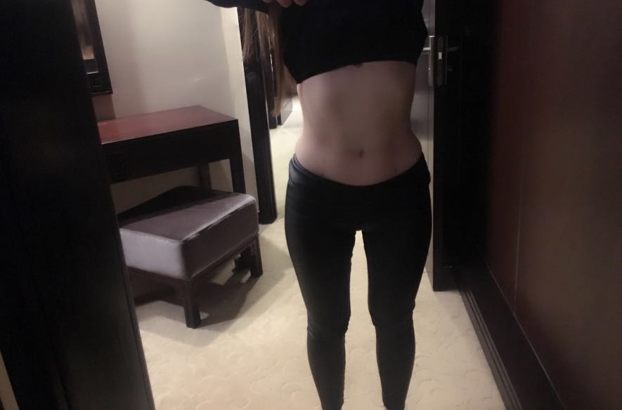 肇慶華美整形醫(yī)院陳巍醫(yī)生做腰腹吸脂效果怎么樣？附腰腹吸脂案例