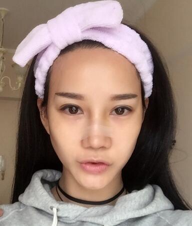 西安陽光整形醫(yī)院邵萍醫(yī)生做鼻綜合整形怎么樣？附鼻綜合整形案例