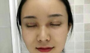 長(zhǎng)沙微笑醫(yī)療整形醫(yī)生段雙軍做切開(kāi)雙眼皮+開(kāi)內(nèi)眼角效果怎么樣？附案例