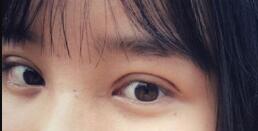 長(zhǎng)沙微笑醫(yī)療整形醫(yī)生段雙軍做切開(kāi)雙眼皮+開(kāi)內(nèi)眼角效果怎么樣？附案例