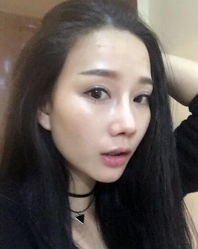 西安陽光整形醫(yī)院邵萍醫(yī)生做鼻綜合整形怎么樣？附鼻綜合整形案例