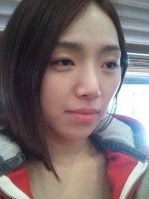 長春中妍整形醫(yī)院吳學(xué)軍醫(yī)生做玻尿酸墊下巴+玻尿酸豐太陽穴案例效果對比圖