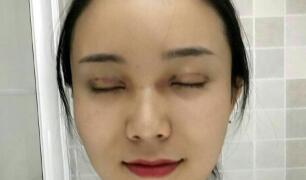 長沙微笑醫(yī)療整形醫(yī)生段雙軍做切開雙眼皮+開內(nèi)眼角效果怎么樣？附案例