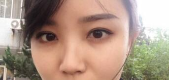 長沙微笑醫(yī)療整形醫(yī)生段雙軍做切開雙眼皮+開內(nèi)眼角效果怎么樣？附案例