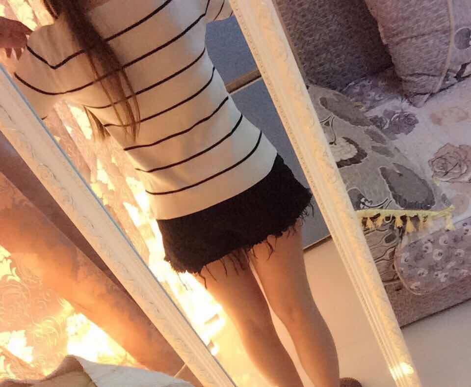 肇慶華美整形醫(yī)院陳巍醫(yī)生做腰腹吸脂效果怎么樣？附腰腹吸脂案例