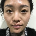 石家莊雅芳亞整形醫(yī)生王文明做雙眼皮+開眼角+鼻綜合整形案例效果對(duì)比圖 石家莊雅芳亞整形醫(yī)生王文明做雙眼皮+開眼角+鼻綜合整形案例效果對(duì)比圖