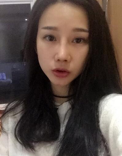 西安陽光整形醫(yī)院邵萍醫(yī)生做鼻綜合整形怎么樣？附鼻綜合整形案例