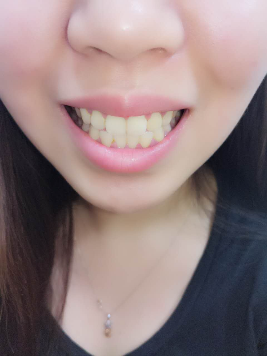 杭州國雅口腔醫(yī)院張虹醫(yī)生做冷光美白效果怎么樣？附冷光美白案例效果對比圖