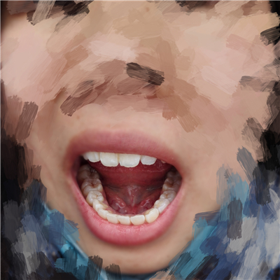 重慶華西牙科醫(yī)院童冠雄超聲波洗牙怎么樣？附超聲波洗牙案例對比圖