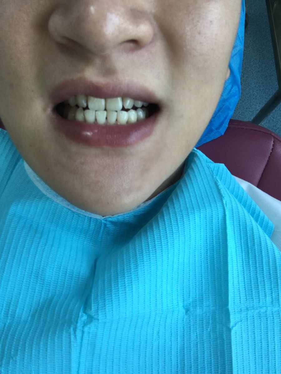 淮北博愛口腔醫(yī)院做牙齒瓷貼面怎么樣？附李龍醫(yī)生案例效果對比圖