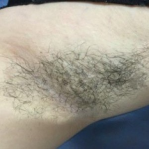 廈門張銘整醫(yī)療整形醫(yī)生張小玲做激光脫腋毛怎么樣？附激光脫腋毛效果對比圖