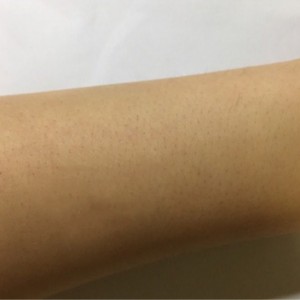 鄭州屈小麗醫(yī)療整形醫(yī)院醫(yī)生劉丹做手臂脫毛怎么樣？附手臂脫毛案例