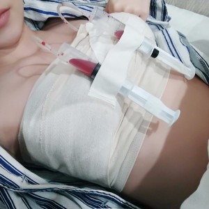 廣州廣大整形美容醫(yī)院醫(yī)生查旭山做假體隆胸怎么樣？附案例