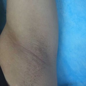 廈門張銘整醫(yī)療整形醫(yī)生張小玲做激光脫腋毛怎么樣？附激光脫腋毛效果對比圖