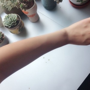 鄭州屈小麗醫(yī)療整形醫(yī)院醫(yī)生劉丹做手臂脫毛怎么樣？附手臂脫毛案例