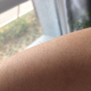 鄭州屈小麗醫(yī)療整形醫(yī)院醫(yī)生劉丹做手臂脫毛怎么樣？附手臂脫毛案例