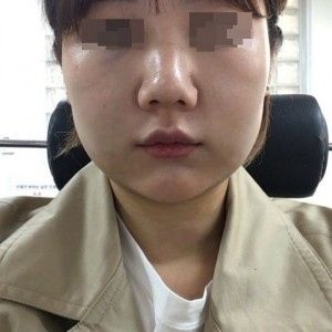 太原麗都整形醫(yī)院劉晉艷醫(yī)生做光纖溶脂瘦臉怎么樣？附案例效果對比圖