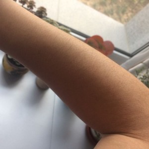 鄭州屈小麗醫(yī)療整形醫(yī)院醫(yī)生劉丹做手臂脫毛怎么樣？附手臂脫毛案例