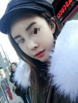 天津時(shí)光整形醫(yī)生盧丙侖做駝峰鼻怎么樣？附案例效果對比圖