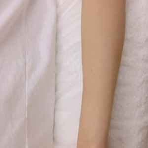 鄭州屈小麗醫(yī)療整形醫(yī)院醫(yī)生劉丹做手臂脫毛怎么樣？附手臂脫毛案例