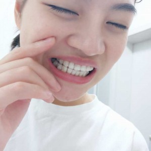 廈門拜博口腔醫(yī)院醫(yī)生張忠做牙齒隱形矯正怎么樣？附案例效果對比圖