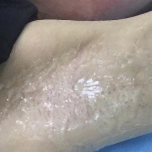 廈門張銘整醫(yī)療整形醫(yī)生張小玲做激光脫腋毛怎么樣？附激光脫腋毛效果對比圖