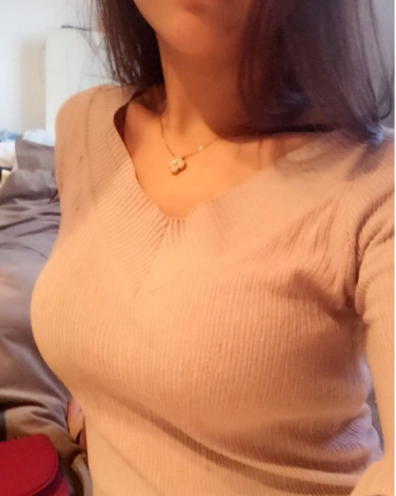 東莞韓美整形醫(yī)院醫(yī)生黃玉潔做假體隆胸怎么樣？附案例效果圖