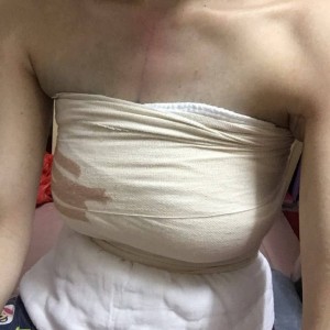 佛山東方女子醫(yī)院整形美容中心姜政輝做自體脂肪隆胸案例效果對比圖