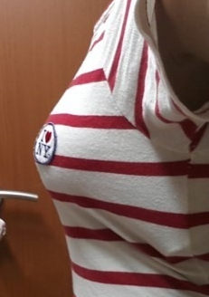 廣州基立嘉韓醫(yī)學整形醫(yī)院醫(yī)生劉朝忠做假體隆胸怎么樣？附案例效果對比圖