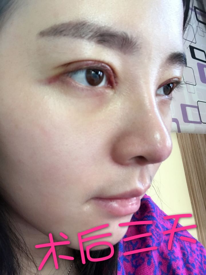 北京京韓整形醫(yī)生王義山做埋線雙眼皮怎么樣？附案例效果對(duì)比圖