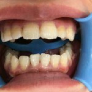 洛陽友好口腔醫(yī)院醫(yī)生楊愛芳做牙齒冷光美白怎么樣？附案例效果圖