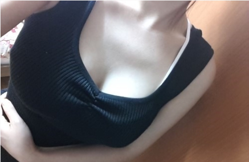 廣州基立嘉韓醫(yī)學整形醫(yī)院醫(yī)生劉朝忠做假體隆胸怎么樣？附案例效果對比圖