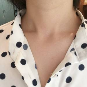 上海名媛醫(yī)療整形醫(yī)生閆嬌君做嗨體去頸紋效果怎么樣？附案例效果圖