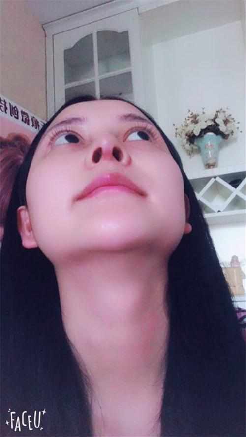鄭州華領醫(yī)療美容醫(yī)院醫(yī)生張永濤做硅膠假體隆鼻怎么樣？附案例效果對比圖