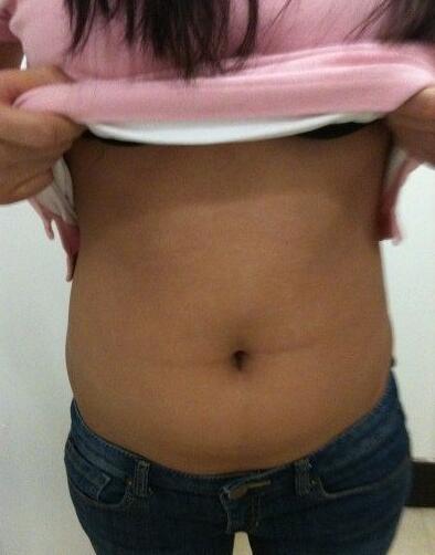 安徽韓美整形醫(yī)院醫(yī)生金壽信做水動力吸脂怎么樣？附案例效果對比圖