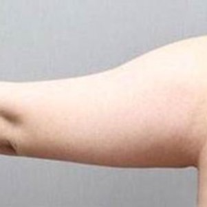 岳陽愛思特醫(yī)療美容醫(yī)院醫(yī)生王福生做手臂吸脂怎么樣？附案例效果圖