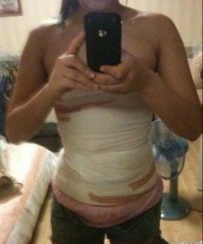 安徽韓美整形醫(yī)院醫(yī)生金壽信做水動力吸脂怎么樣？附案例效果對比圖