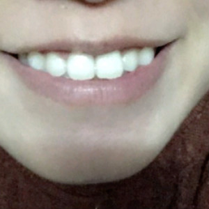 洛陽(yáng)友好口腔醫(yī)院醫(yī)生楊愛(ài)芳做牙齒冷光美白怎么樣？附案例效果圖