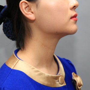 上海名媛醫(yī)療整形醫(yī)生閆嬌君做嗨體去頸紋效果怎么樣？附案例效果圖