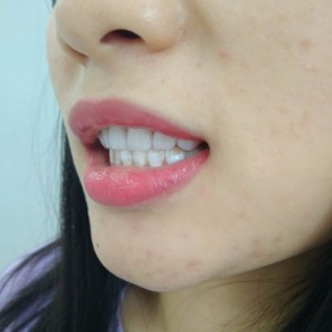 黔西南興義京州口腔醫(yī)院醫(yī)生徐勇做牙貼面怎么樣？附案例效果對(duì)比圖