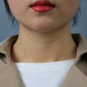 上海名媛醫(yī)療整形醫(yī)生閆嬌君做嗨體去頸紋效果怎么樣？附案例效果圖