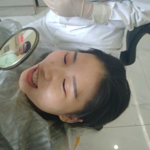 洛陽友好口腔醫(yī)院醫(yī)生李新然做牙貼面怎么樣？附案例效果圖