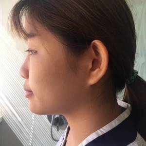 北京京民醫(yī)院整形外科醫(yī)生李鴻儒做硅膠隆鼻怎么樣？附案例效果圖