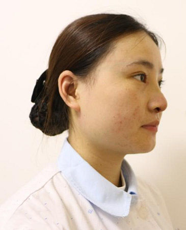 1528339523944399.jpg 深圳陽光整形美容醫(yī)院醫(yī)生張平做膨體隆鼻+雙眼皮+注射瘦臉案例效果對比圖