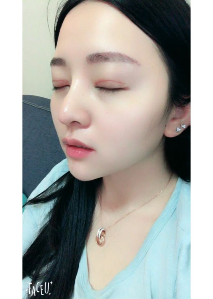 北京京韓整形醫(yī)生王義山做埋線雙眼皮怎么樣？附案例效果對(duì)比圖