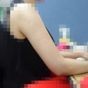 岳陽愛思特醫(yī)療美容醫(yī)院醫(yī)生王福生做手臂吸脂怎么樣？附案例效果圖