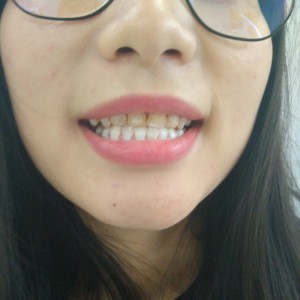 洛陽友好口腔醫(yī)院醫(yī)生李新然做牙貼面怎么樣？附案例效果圖