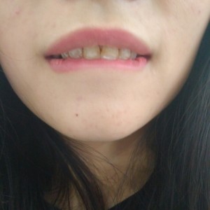 黔西南興義京州口腔醫(yī)院醫(yī)生徐勇做牙貼面怎么樣？附案例效果對(duì)比圖